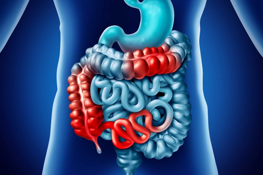 Morbo di Crohn: Cosa Mangiare e Cosa no