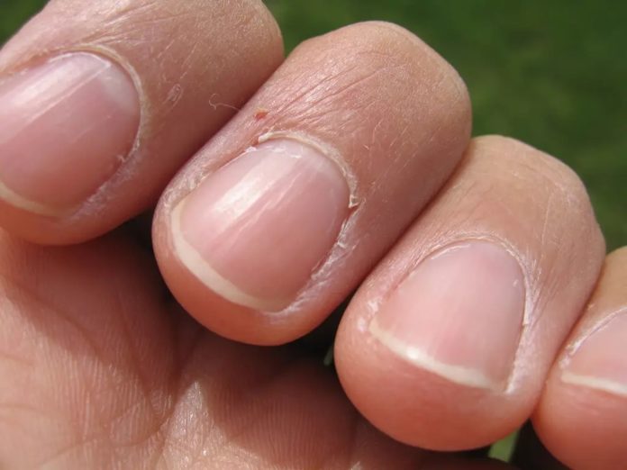 J’ai les ongles striés : symptômes, causes et traitements - Metamag