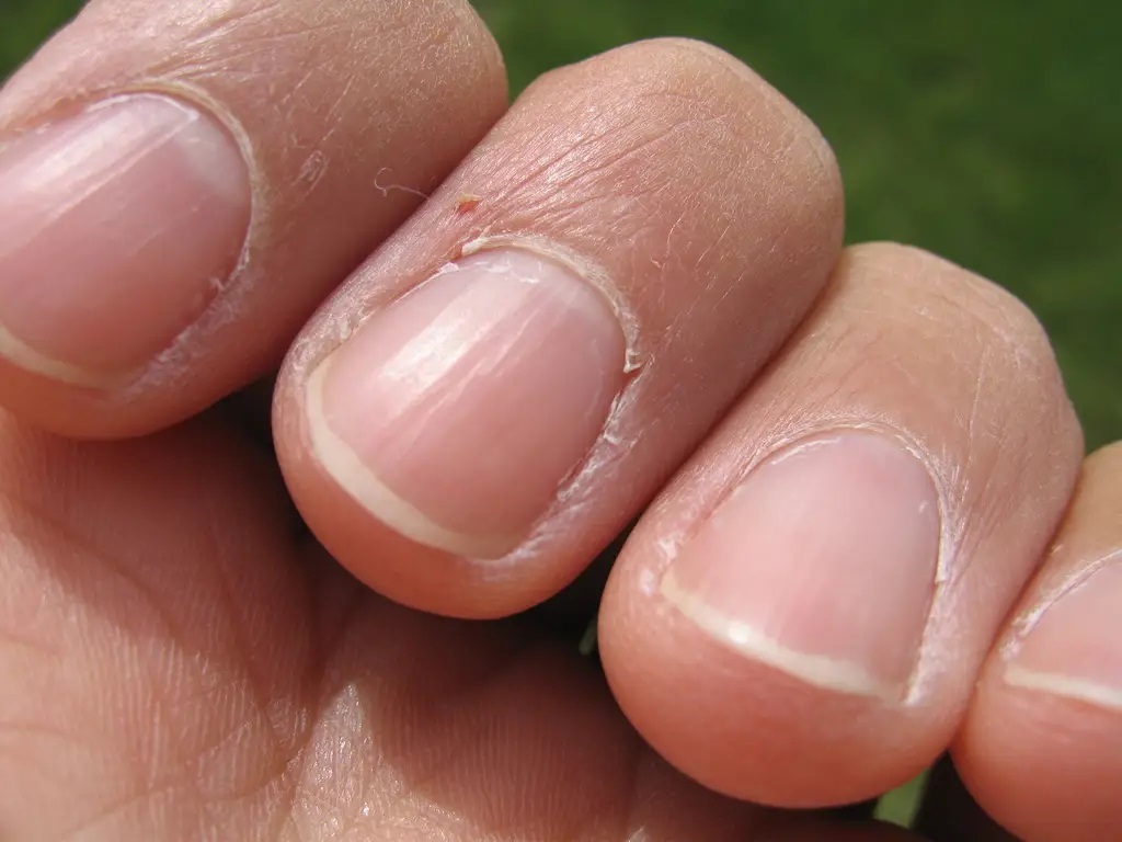 traitements pour les ongles striés