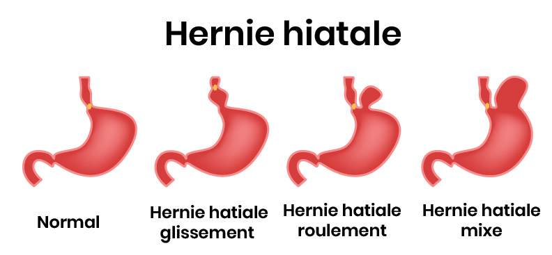 types de hernie hiatale 