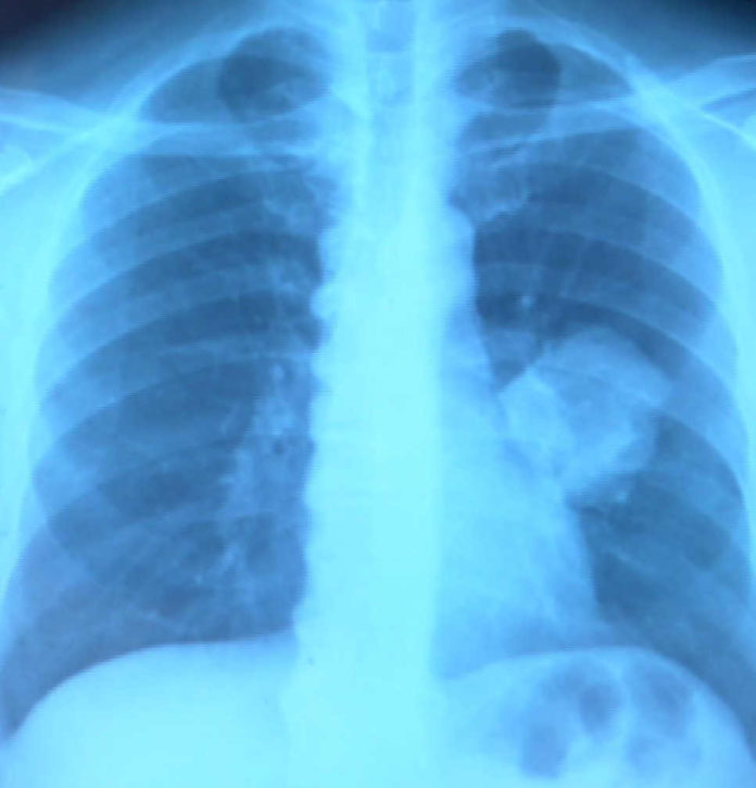 Étude NADIM : les premiers patients atteints de cancer du poumon survivent plus de trois ans

