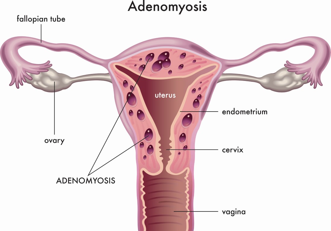 Schéma de présentation de l'adénomyose