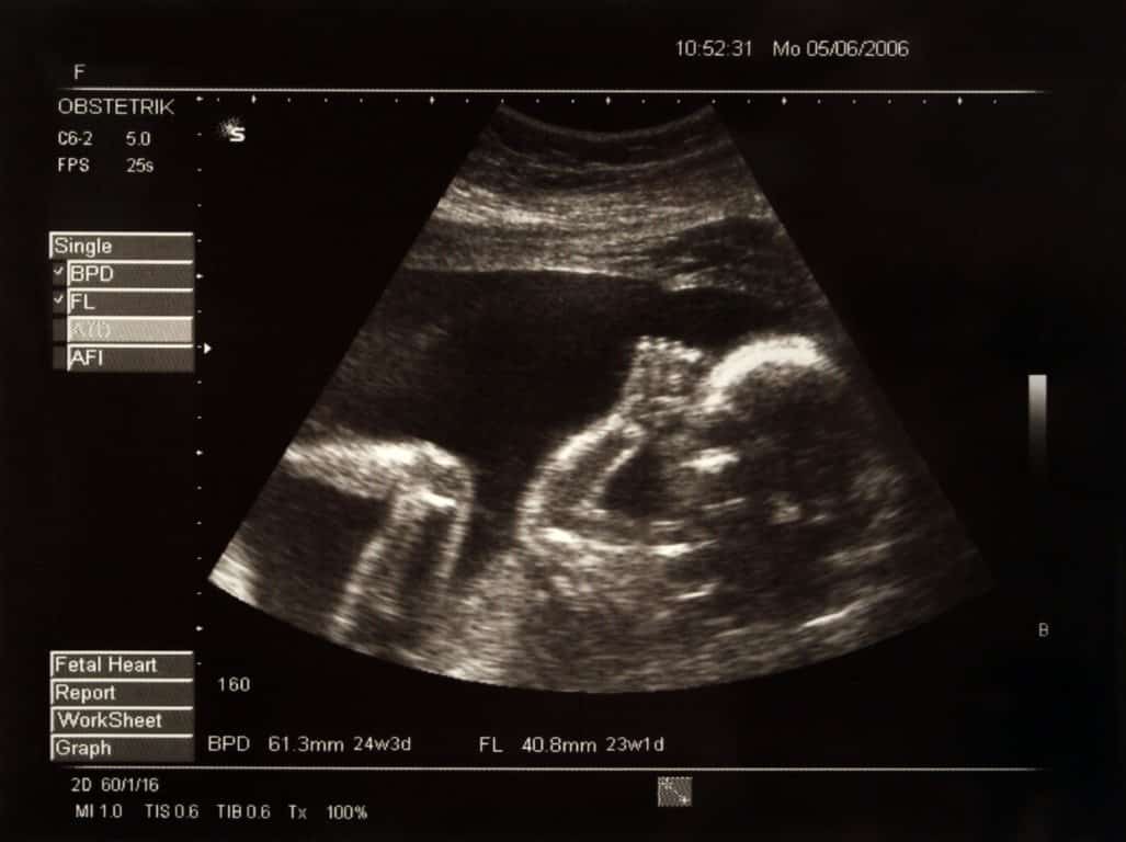 Vue d'un fœtus via une échographie