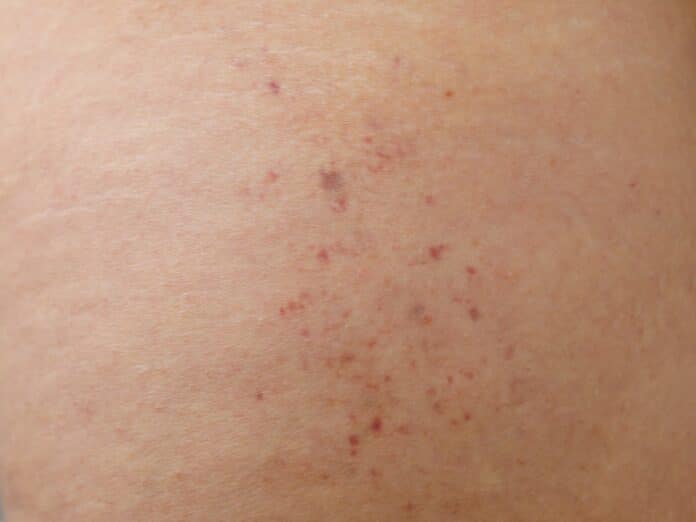 De petits points rouges indolores apparaissant sur la peau