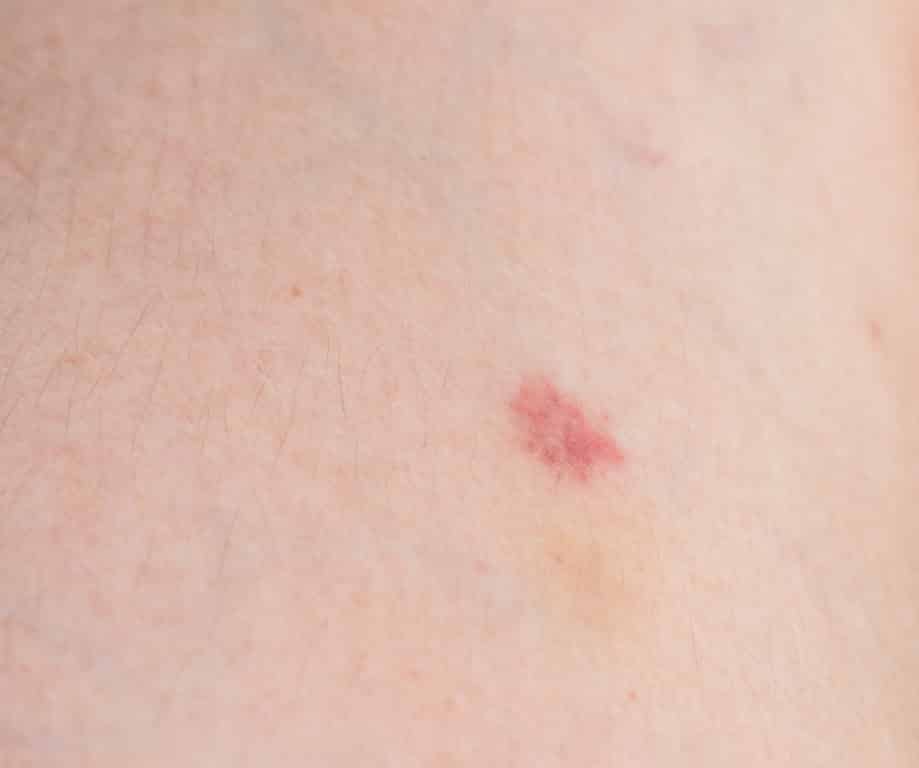 Une autre forme de points rouges apparaissant sur la peau