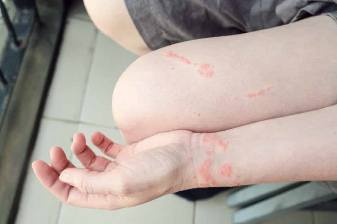 Réaction allergique provoquée par une piqure de méduse