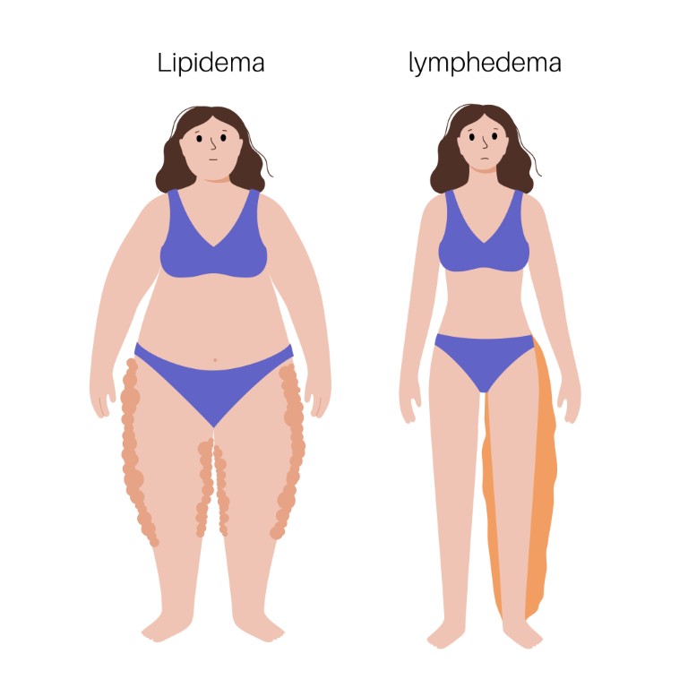 lipœdème ou lymphœdème